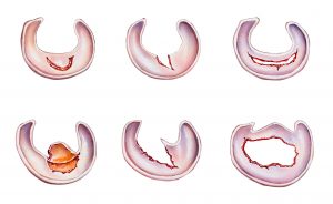 Meniscus tears in the human knee. Shown are a longitudinal tear (top left) that may develop into a bucket handle tear (top right); a radial tear (center left) that may develop into a parrot beak tear (center right); and a horizontal tear (bottom left) that may develop into a flap tear (bottom right).